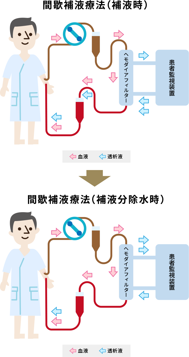 血液透析（HD）